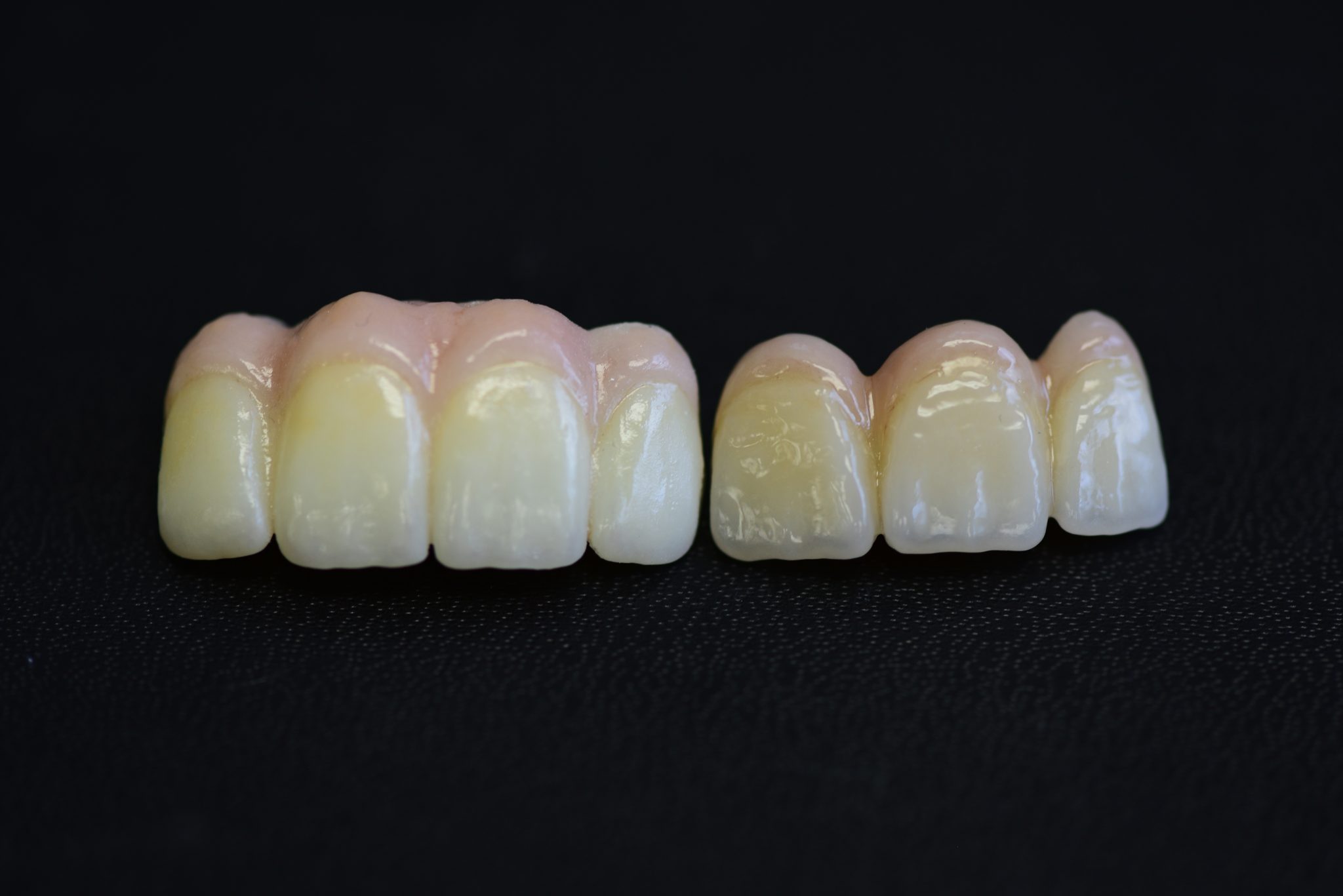 emax-crowns-vs-zirconia-crowns-the-beauty-and-the-beast-schack