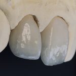 Emax Crowns vs. Zirconia Crowns: The Beauty and the Beast