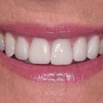 Create a More Youthful Smile with Porcelain Veneers