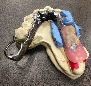Read more on Digital Workflow to fit a Crown under a Partial Denture